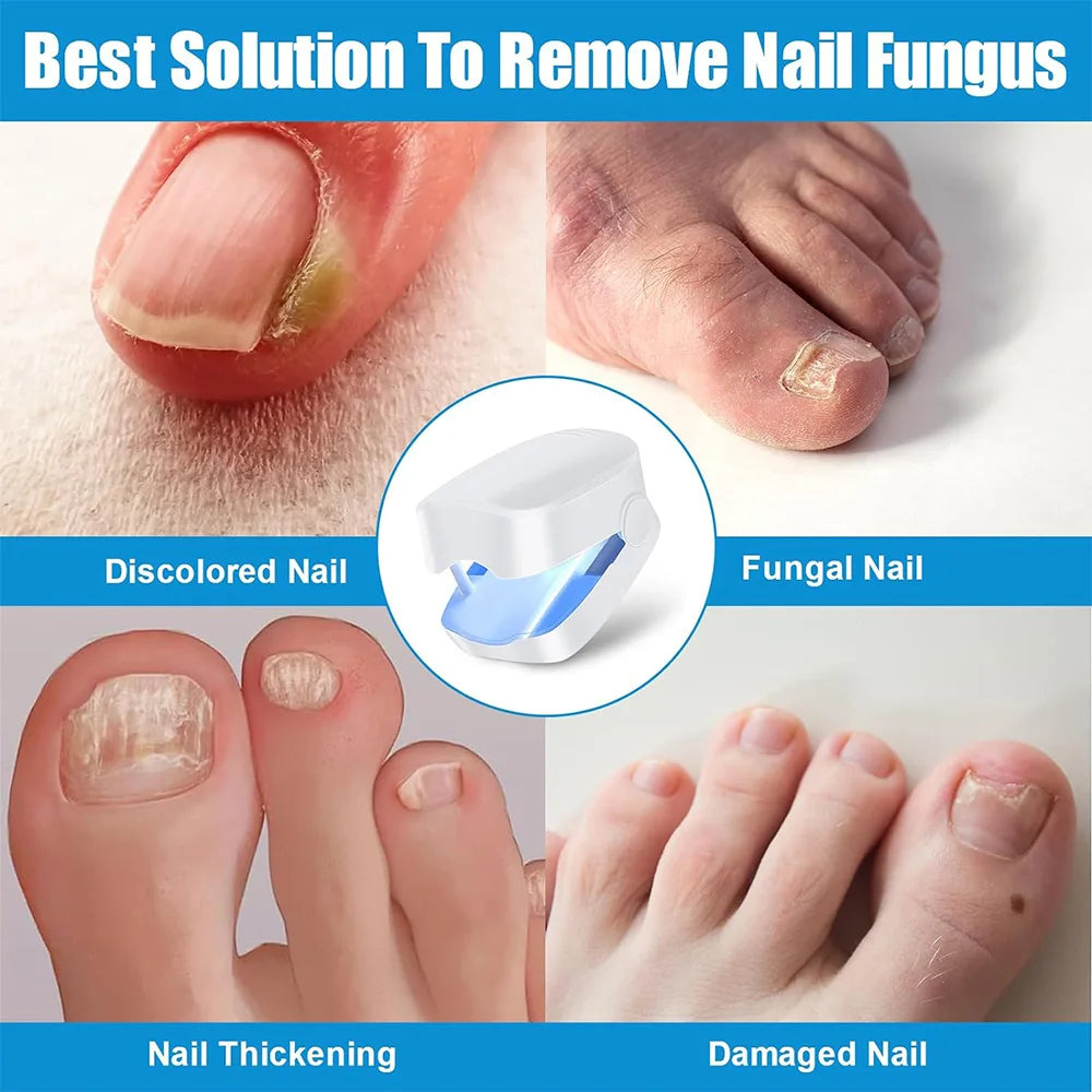 Nail Fungus Treatment LED Laser Device for Cleaning Onychomycosis USB Charge 905nm Infrared Light 470nm Blue Light Nail Salon